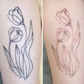 ★문신, 타투 제거 체험단 - 시술 후 관리도 중요! 통증경감시술