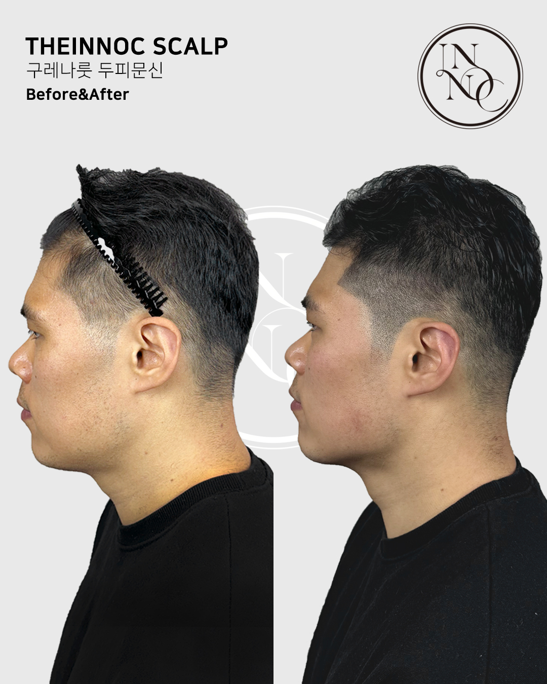 [인천 서구]300만원상당의 헤어라인 체험권! 연예인도 선택한 트렌디하고 신뢰할 수 있는 