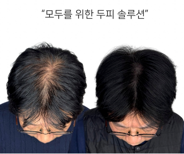 [경기 성남]머리숱이 적은 머리에 자신감을 뿜뿜 심어드리겠습니다 최고의 퀄리티 두피 문신 