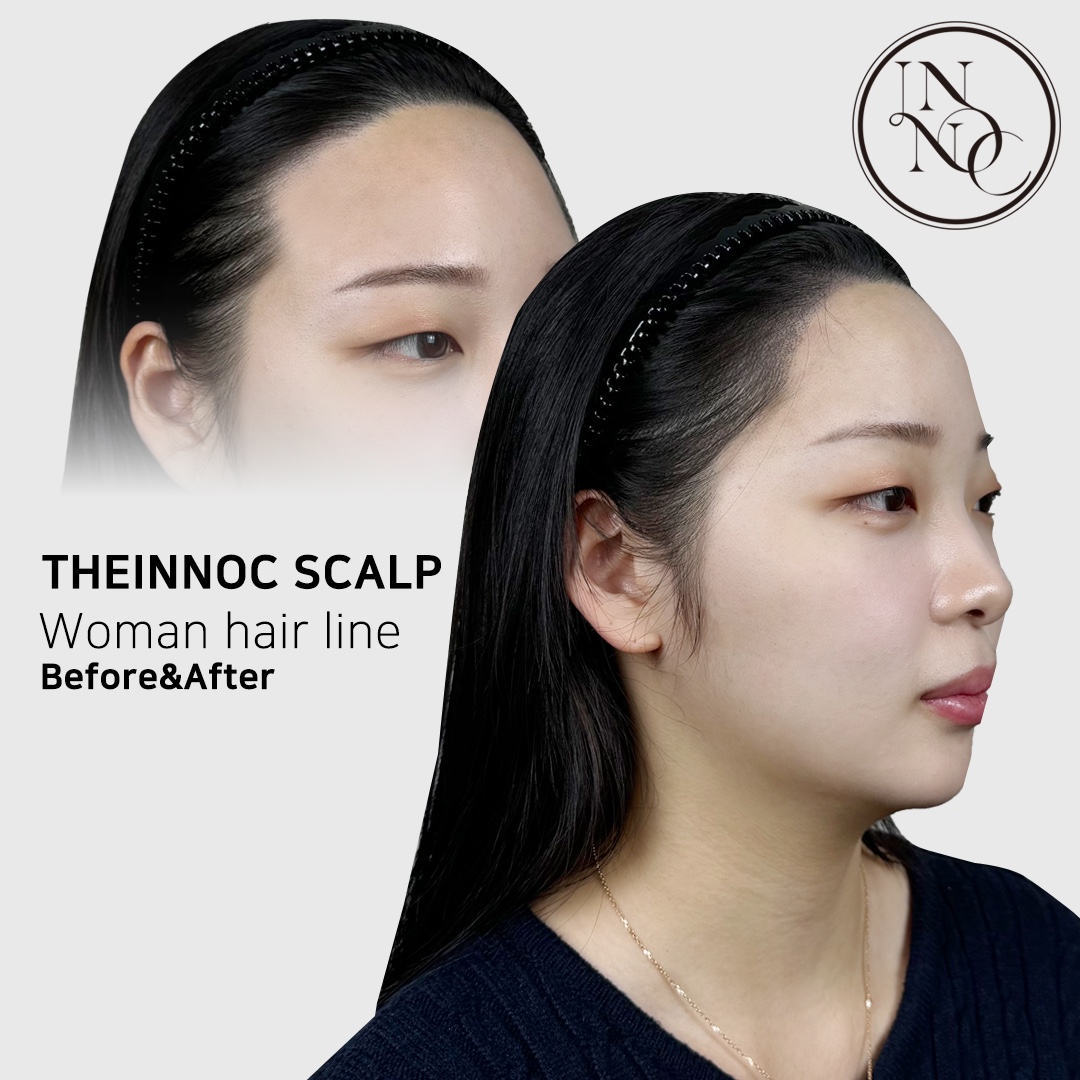 [인천 서구]150만원상당의 헤어라인 체험권! 연예인도 선택한 트렌디하고 신뢰할 수 있는 