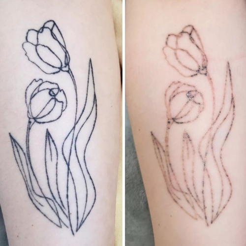 [서울 강남]★문신, 타투 제거 체험단 - 시술 후 관리도 중요! 통증경감시술